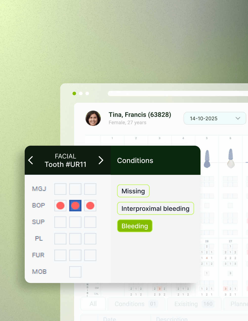 Simplify perio charting Dental chart interface showing patient info with highlighted conditions for Tooth #UR11, including missing, interproximal bleeding, and bleeding.